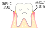 歯垢がたまる。歯肉に炎症。