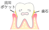 歯周ポケット、歯垢。