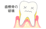 歯槽骨の破壊。